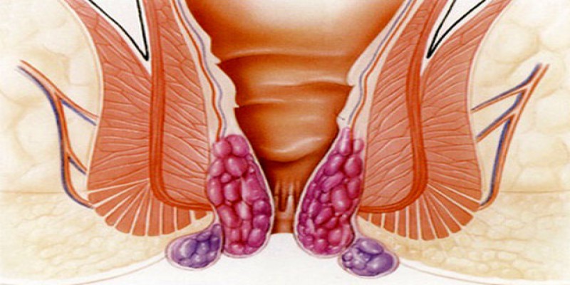 چگونه می توان هموروئید را با روش های طبیعی درمان نمود؟