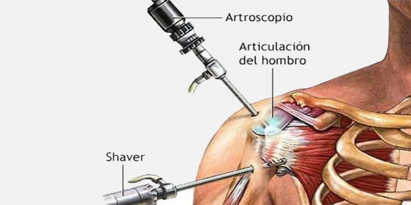 آرتروسکوپی شانه