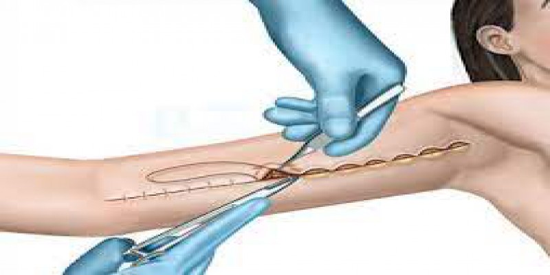 جراحی لیفت بازو با لیپوساکشن چگونه است؟