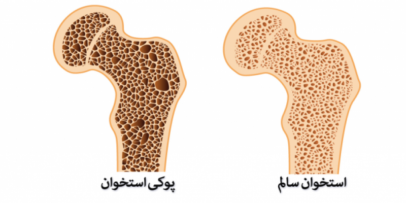 تست تراکم استخوان