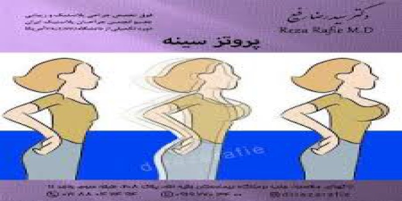 فیزیوتراپی سینه