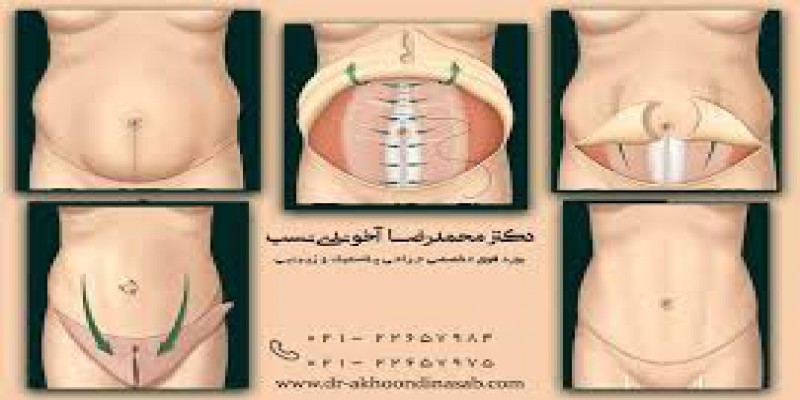 اقدامات قبل از جراحی کشیدن پوست شکم