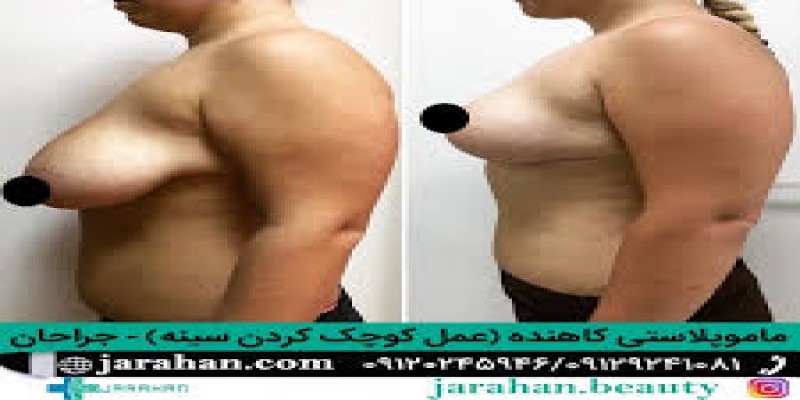 اقدامات قبل از جراحی کوچک کردن سینه