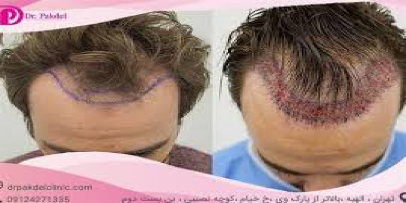 من دچار ریزش مو شده ام باید چه کار کنم؟