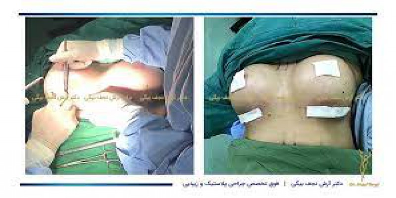 لیفت سینه Breast Lifts