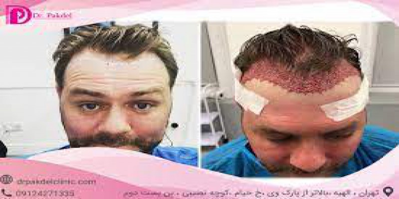 فعالیت های سنگین مثل باشگاه تا چه مدت بعد از کاشت مو مجاز نیست؟