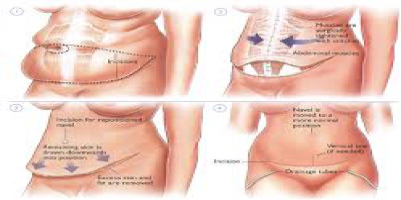 روند لیفت شکم بدون جراحی