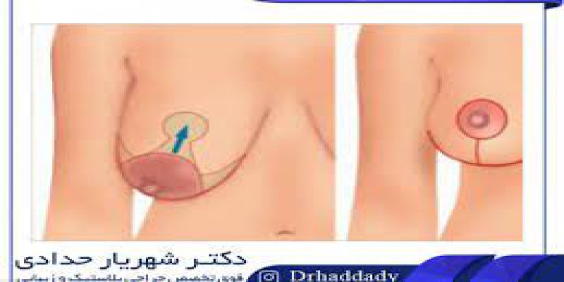 جراحی بازسازی سینه breast reconstruction