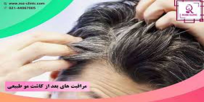 چرا باید کاشت مو انجام شود؟