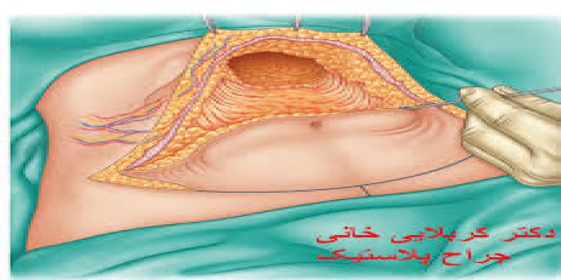 آیا انجام جراحی ابدومینوپلاستی منجر به کاهش وزن می شود؟