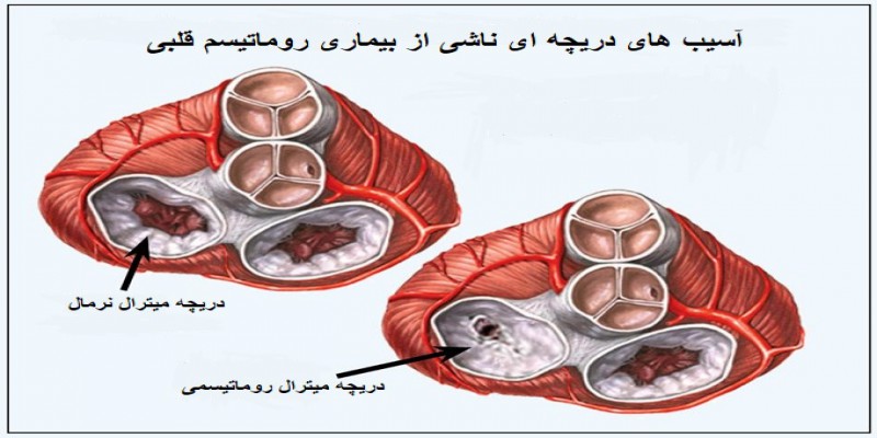 روماتیسم قلبی