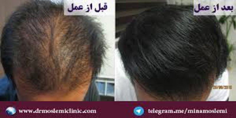 چه میزانی از ریزش مو طبیعی است؟