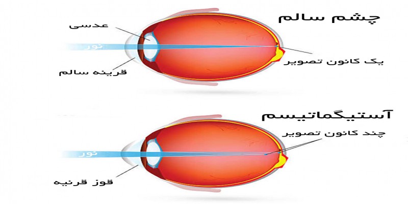 آستیگماتیسم