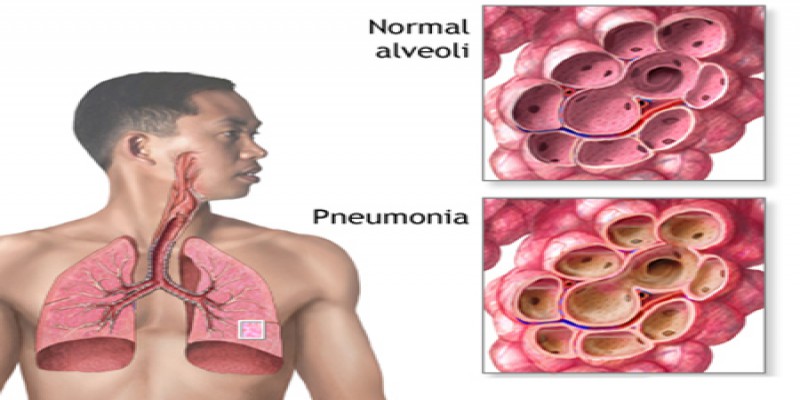 پنومونی یا ذات الریه