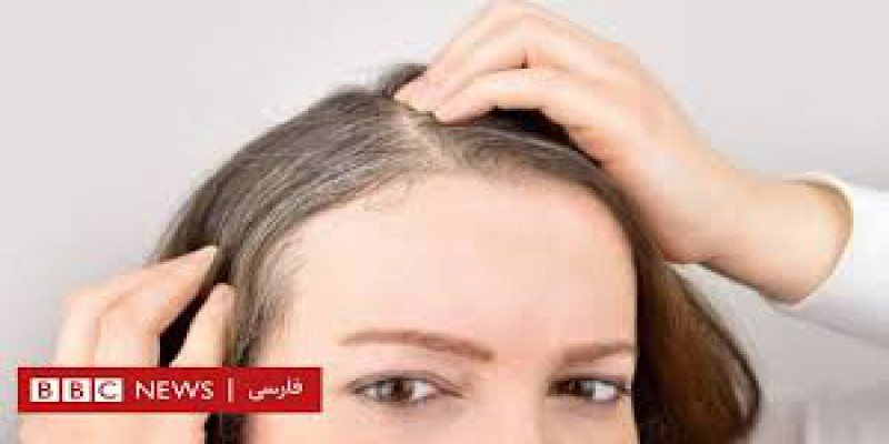 چه مدت پس از بهبودی کرونا ریزش مو اتفاق میوفتد؟