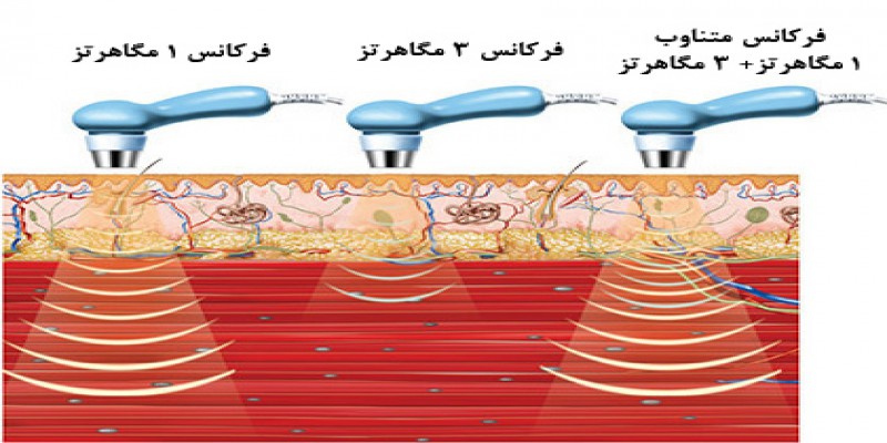 اولتراسوند درمانی