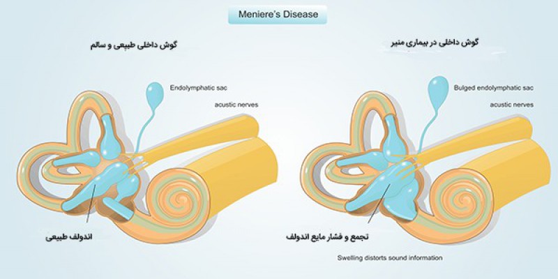 بیماری منییر