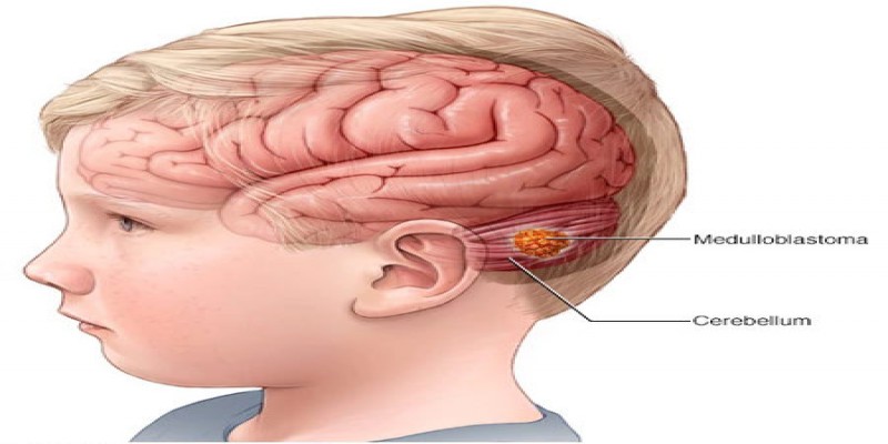 مدولوبلاستوما